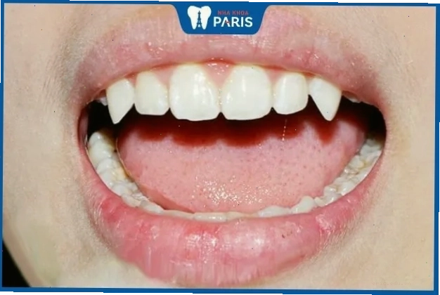 Phụ nữ có răng nhọn, đều đẹp thường có tính cách sôi nổi và thông minh