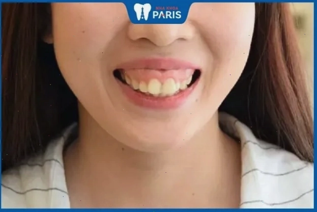 Phụ nữ răng hô vẩu mất thẩm mỹ được niềng răng để cải thiện nụ cười