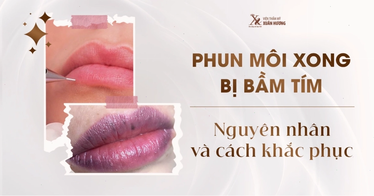 Phun môi xong bị bầm tím và cách xử lý