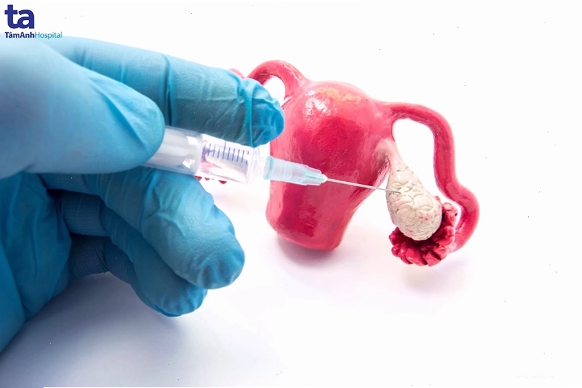 Quy trình quan trọng của IVF và IUI