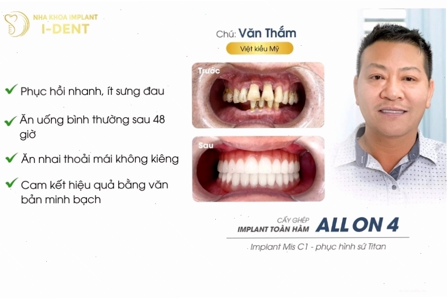 Quy trình trồng răng implant