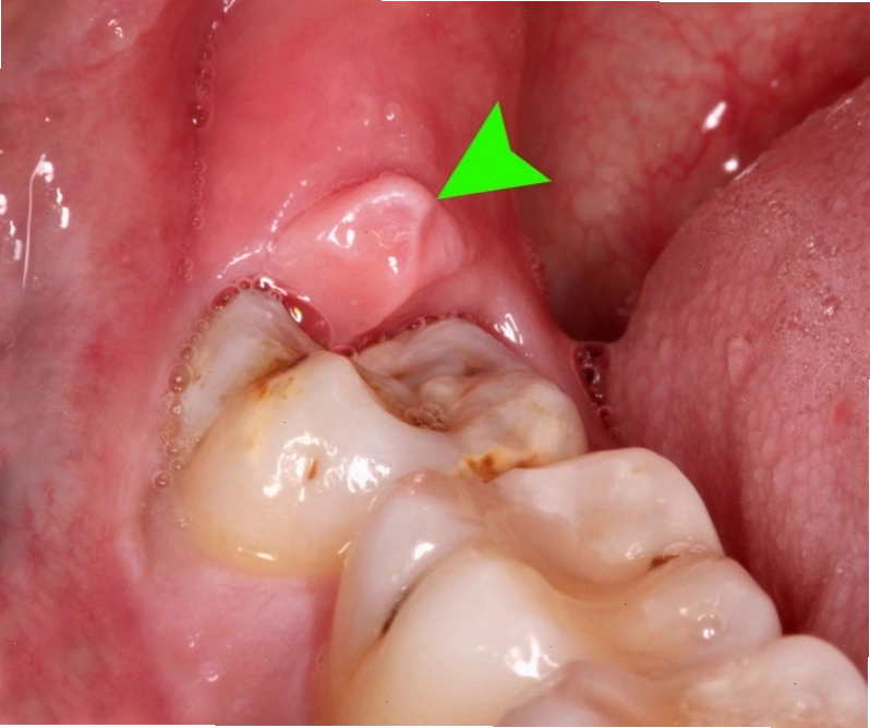 Răng khôn nếu không vệ sinh sạch sẽ sẽ gây viêm lợi