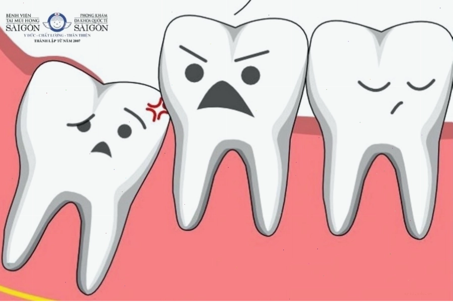 Răng khôn thường mọc sau khi xương hàm đã phát triển hoàn toàn