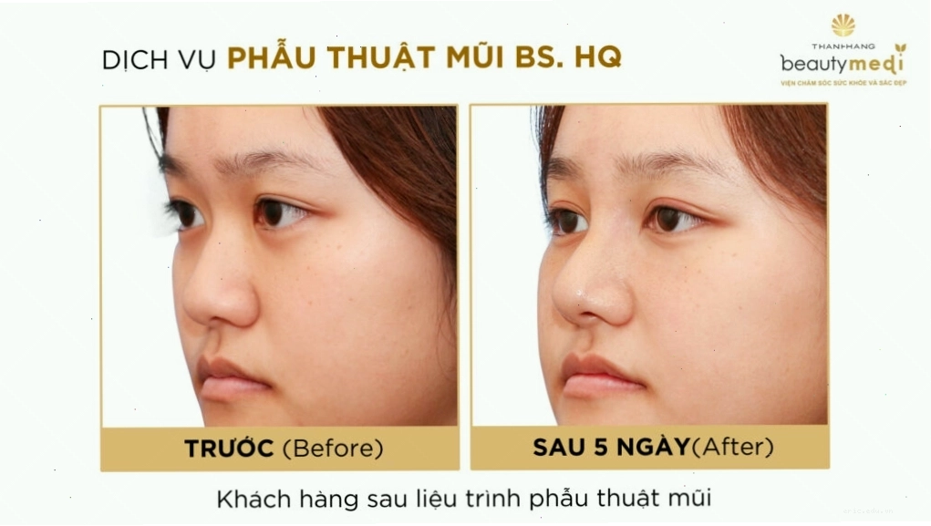 So sánh trước và sau khi phẫu thuật mũi tại Beauty Medi