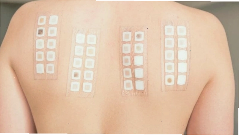 Test dị ứng để xác định nguyên nhân gây bệnh chàm