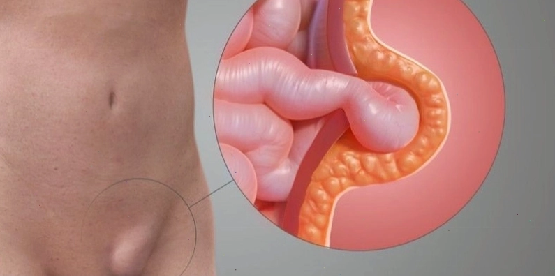 Thoát vị bẹn là một trong những nguyên nhân gây đau bụng dưới bên trái.