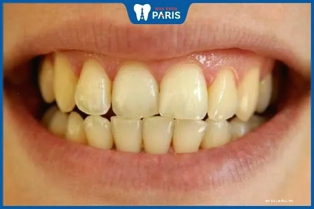 Tình trạng răng ố vàng và cách khắc phục hiệu quả