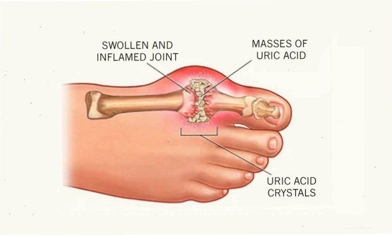 Triệu chứng bệnh gout là dạng viêm khớp sưng đỏ ở các vị trí khớp trên cơ thể khiến bệnh nhân đau dữ dội