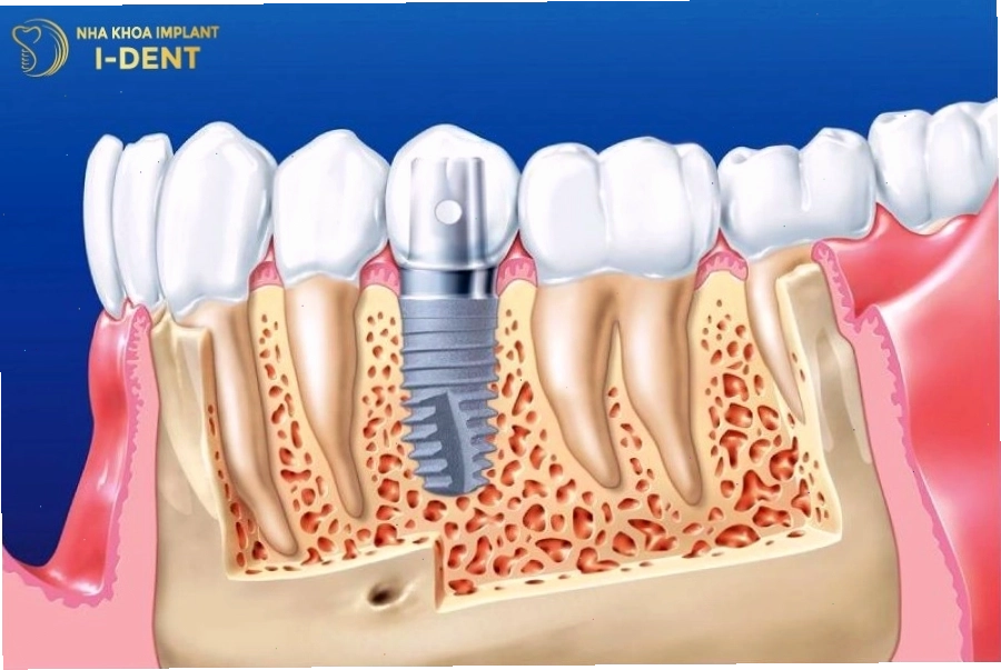 Trụ implant có tính tương thích sinh học cao