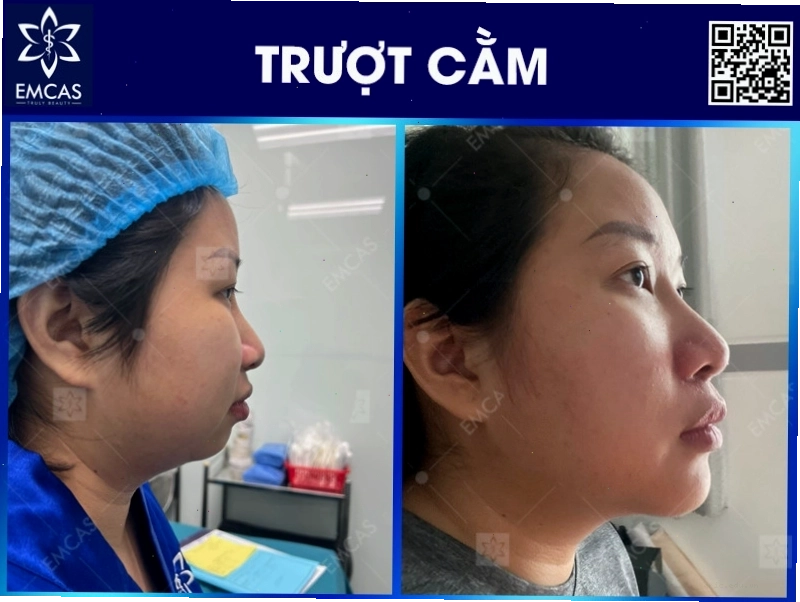 Trượt Cằm Và Những Điều Cần Biết