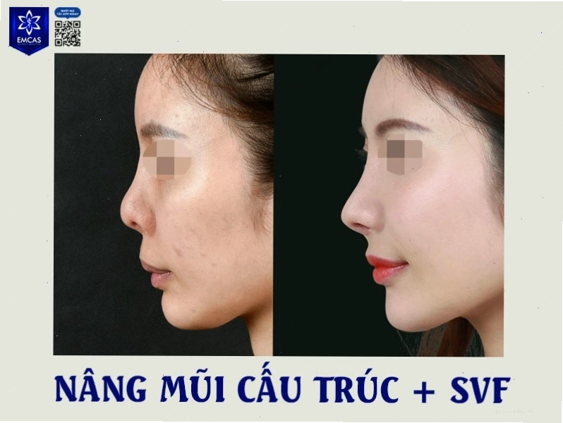 Tư vấn chỉnh sửa mũi hợp phong thủy