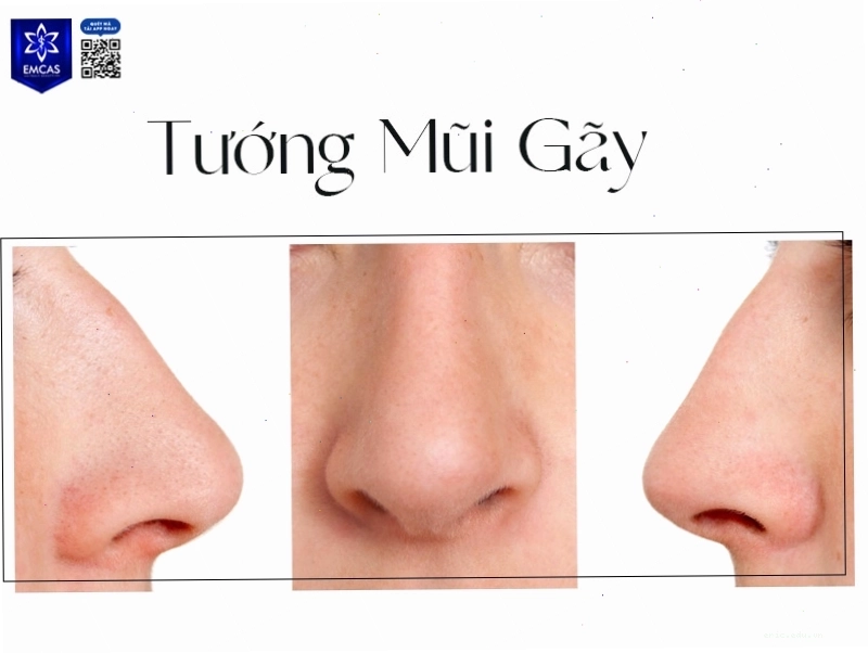 Tướng mũi gãy đàn ông có thể gặp trắc trở trong sự nghiệp