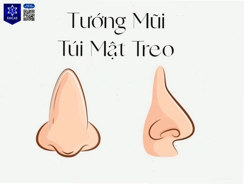 Tướng mũi túi mật treo đàn ông mang lại cuộc sống sung túc