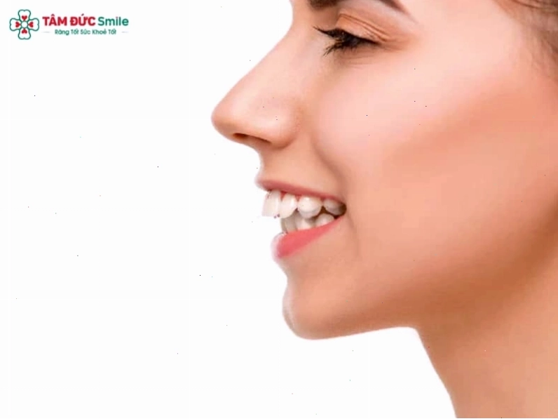 Tướng phụ nữ răng hô với nụ cười kém duyên và ảnh hưởng đến tự tin giao tiếp