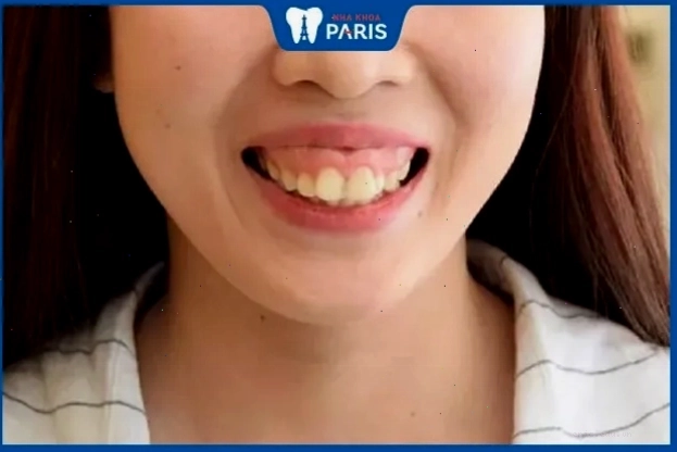 Tướng răng hô vẩu ở phụ nữ và ý nghĩa trong xem tướng