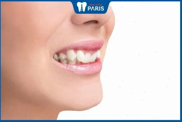 Tướng răng khấp khểnh ở phụ nữ và ý nghĩa phong thủy