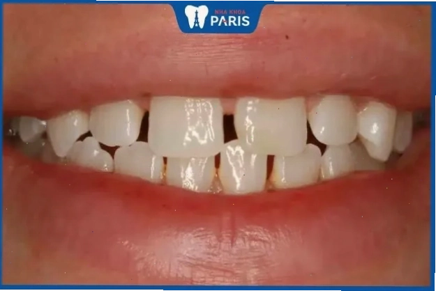 Tướng răng thưa có thể được cải thiện bằng các phương pháp nha khoa