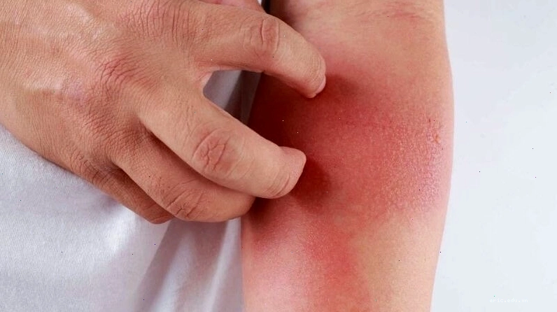 Vòng lặp ngứa gãi gây viêm da thần kinh do bệnh chàm