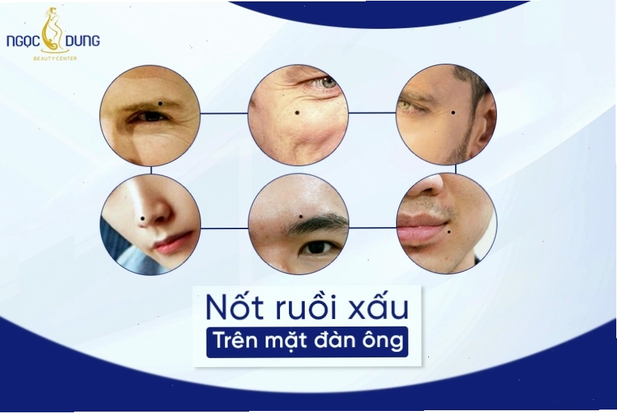 Xem tướng nốt ruồi xấu trên mặt đàn ông đoán tính cách