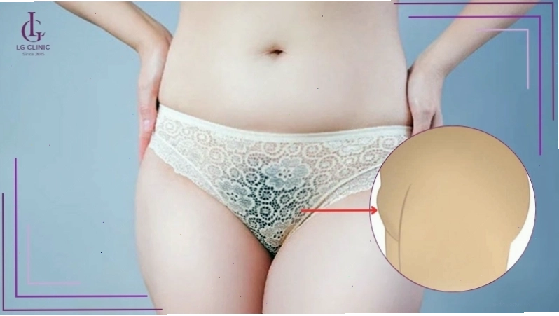 Xương mu nhô cao có kèm lông rậm