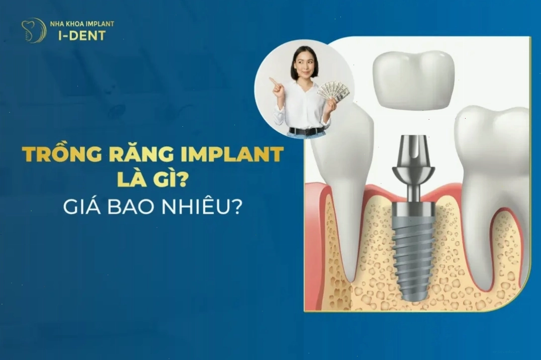 Yếu tố quyết định thành công khi trồng implant