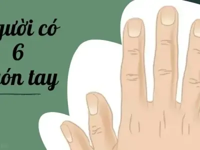 Người có 6 ngón tay tốt hay xấu ảnh hưởng vận mệnh gì?