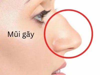 Giải mã nhân tướng học tướng mũi gãy trong cuộc sống