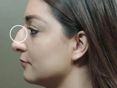 Nhận diện tướng mũi gồ và ý nghĩa trong nhân tướng học