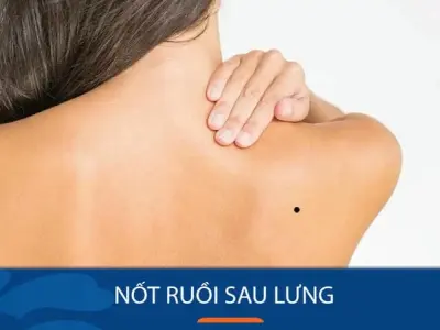 Giải mã ý nghĩa khi xem tướng qua nốt ruồi trên lưng