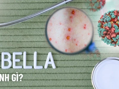 Bệnh Rubella là gì? Nguyên nhân, triệu chứng và cách phòng ngừa hiệu quả