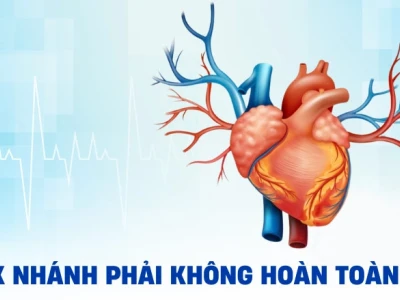 Block Nhánh Phải Không Hoàn Toàn: Nguyên Nhân, Triệu Chứng và Cách Xử Lý