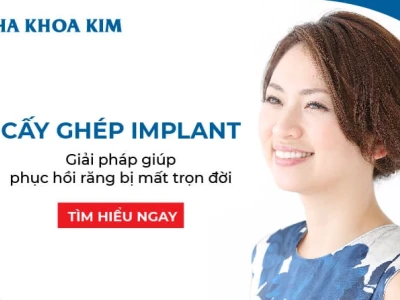 Cấy ghép Implant là gì? Bí quyết sở hữu hàm răng chắc khỏe bền lâu