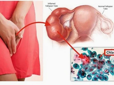 Chlamydia là gì? Nguyên nhân, triệu chứng và cách phòng ngừa hiệu quả