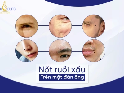Giải mã nốt ruồi trên mặt đàn ông: Xem tướng vận mệnh, tính cách chi tiết