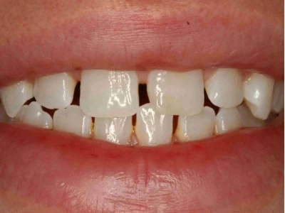 Giải mã tướng số người có răng thưa: Cát hay hung?