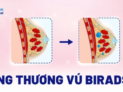 Sang thương vú BIRADS 2 là gì? Ý nghĩa và cách xử lý