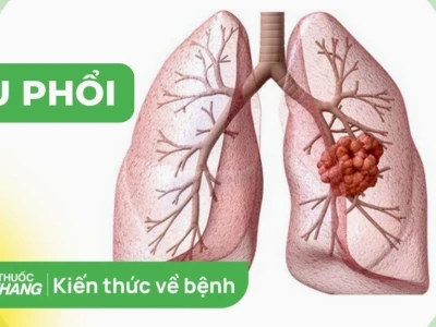 U phổi là gì? Phân loại, nguyên nhân và cách chẩn đoán chi tiết
