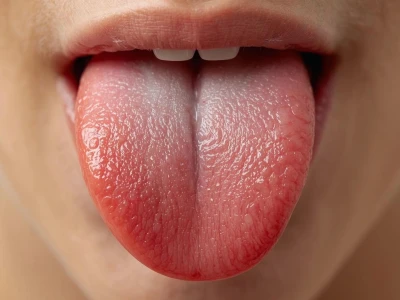 Viêm Gai Lưỡi Là Gì? Nhận Biết Dấu Hiệu và Biện Pháp Xử Lý Hiệu Quả